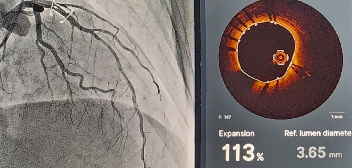 Zayer_h's tweet photo. Anterior #STEMI treated with #PCI to the ostial LAD, was referred for re-look angiography for stent optimization.
#OCT showed excellent stent expansion with proper coverage of the LAD ostium and only few struts in the LM.
@PCRonline @SACIS_KSA @AbbottCardio
#PrecisionPCI https://t.co/8Ow0ya7YbJ