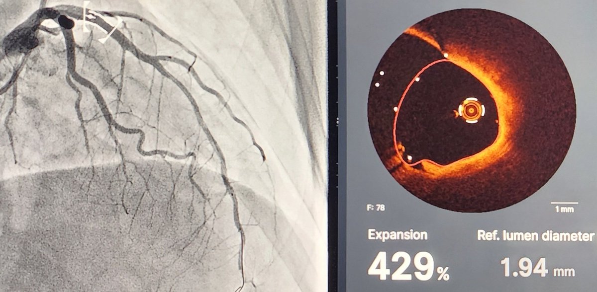 Zayer_h's tweet photo. Anterior #STEMI treated with #PCI to the ostial LAD, was referred for re-look angiography for stent optimization.
#OCT showed excellent stent expansion with proper coverage of the LAD ostium and only few struts in the LM.
@PCRonline @SACIS_KSA @AbbottCardio
#PrecisionPCI https://t.co/8Ow0ya7YbJ