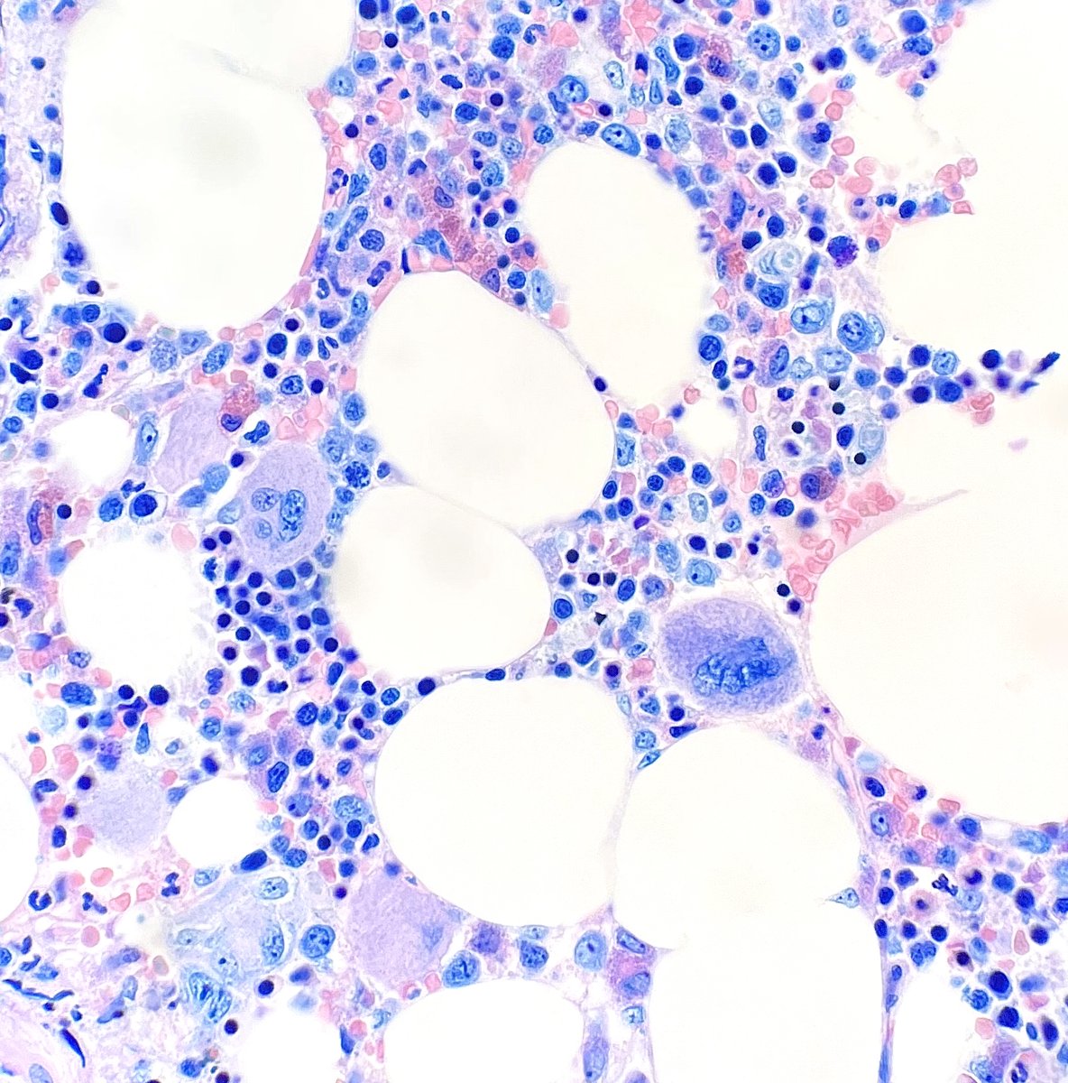 In #hemepath what is more satisfying than a well-stained giemsa? #pathology #pathtwitter