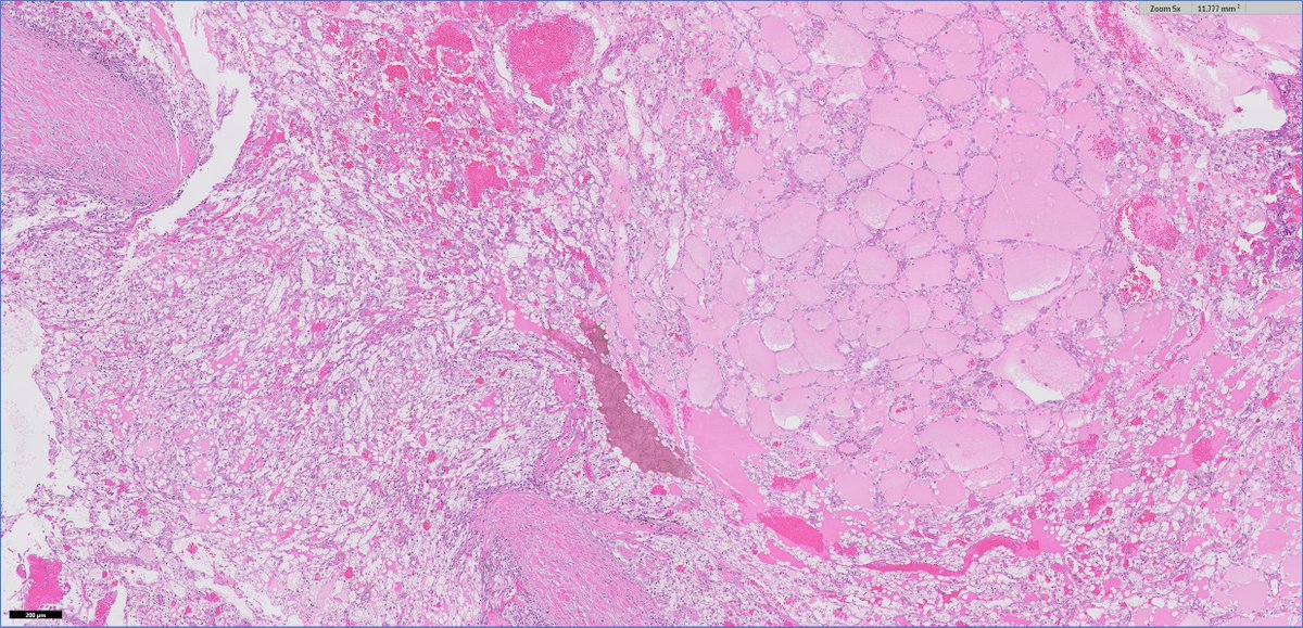 slusagar's tweet image. getting #endopath vibes from #GUpath kidney?

sometimes clear cell RCC (as shown) can have luminal secretion vaguely reminiscent of thyroid follicles (and mimic thyroid-like follicular carcinoma of kidney)