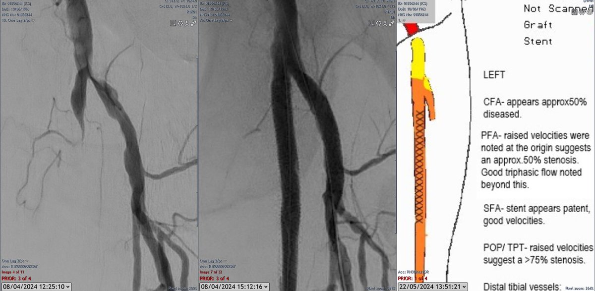 1st toe dry necrosis, patient with comorbidities ++. ATA in line flow to 'woundosome'. CFA Shockwave and stenting of SFA (Supera Presto technique) and PFA (Shockwave and Xcience BTK). Duplex @ 6 weeks with very happy patient. @FadiSaab17 @EndovascularU @a_saratzis @K_Stavroulakis