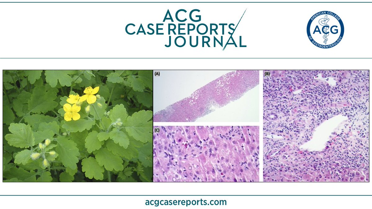 🔎 ACG Case Reports Journal 🔍

A Yellow Flower With Jaundice Power: Liver Injury Attributed to Greater Celandine
Sydney Power, MD & A. Sidney Barritt, IV, MD, MSCR, FACG, for the Drug-Induced Liver Injury Network
👉 bit.ly/4bNZk9l

@sidbarritt4 @KhushbooSGala @VibhuC_MD