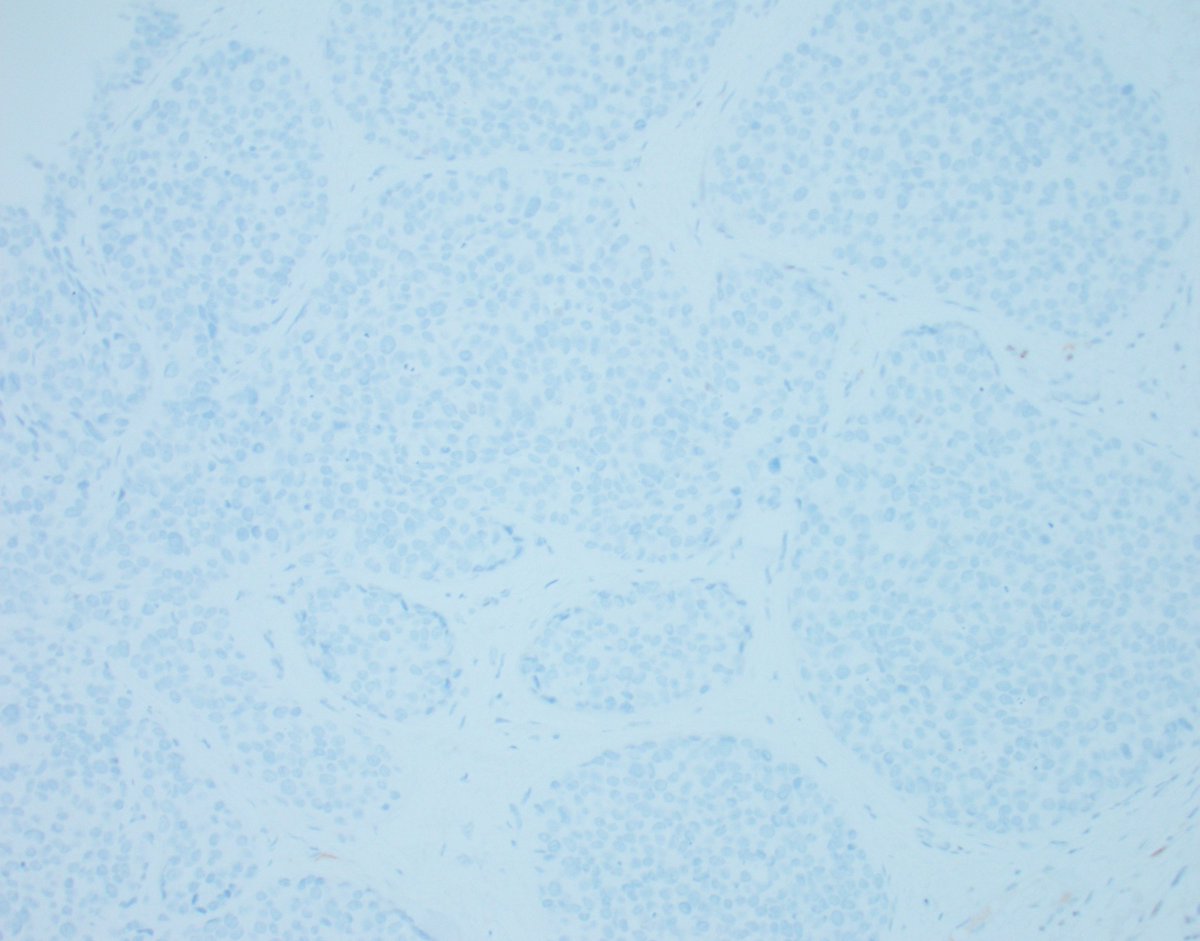 This is a consult case that was already stained. The question was: Could this be UDH given the mosaic-pattern of CK5/6 positivity (image 2)? The answer is NO, because the cytology is malignant. Basal-like DCIS can express CK5/6 as seen in this case, either diffusely or variably.