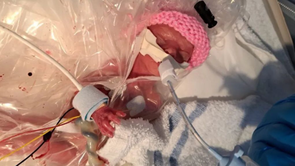 Premature Baby Born at 22 Weeks, Size of Her Father’s Hand, Celebrates Her First Birthday buff.ly/44UpGUL