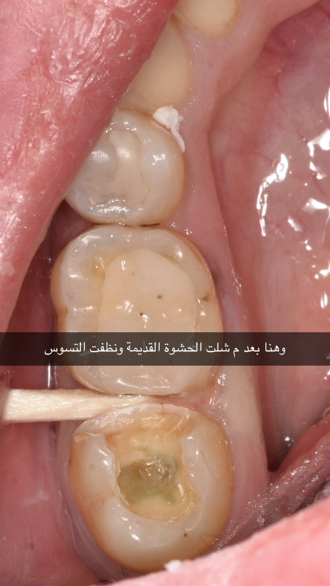 8Munther's tweet photo. استبدال حشوة كانت تسبب رائحة كريهة وتجمع أكل : 
خطوات العلاج في الاسفل 👇🏻 https://t.co/8VE9WRdJlZ