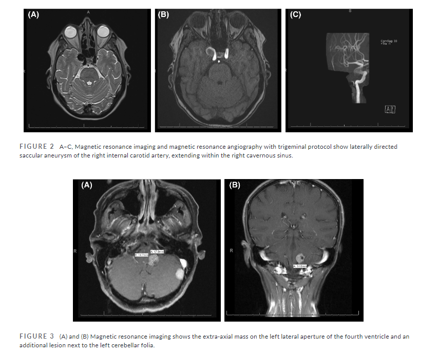 Open Access: A systematic review & case series of #HemicraniaContinua found several potential secondary causes & identified importance of neuroimaging …adachejournal.onlinelibrary.wiley.com/doi/full/10.11… @kathleen_digre @MCortez_DO @OzudogruSeniha et al