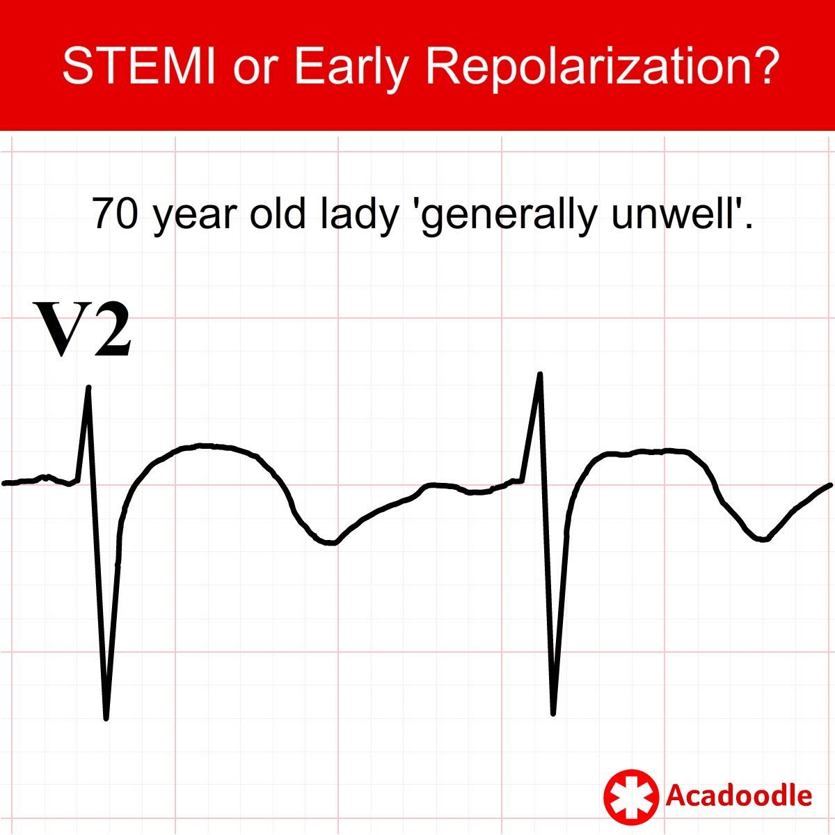 What do you think... STEMI or early repolarization? Learn more at acadoodle.com #emergencymedicine #intensivecare #respiratory #respiratorycare #icu #nurses #icunurse #ecg #ekg #cme #cmeonline