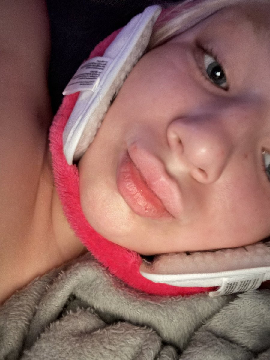 Swollen asf, I got my wisdom teeth out yall