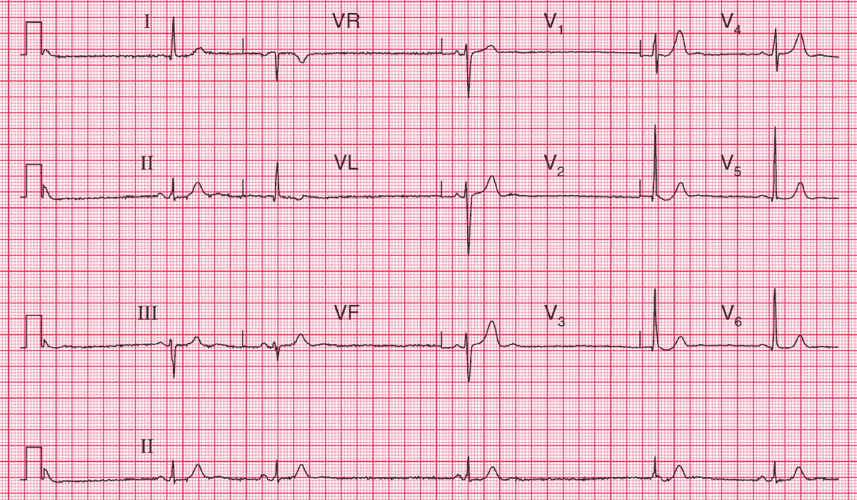 25 y/o man with episodes of fast, regular, palpitations associated with breathlessness and dizziness.
- What is the diagnosis and how can his problem be treated?

➡️ Answer and Interpretation: manualofmedicine.com/ecgs/ecg-case-…

#medtwitter #foamed #cardioed #cardiotwitter