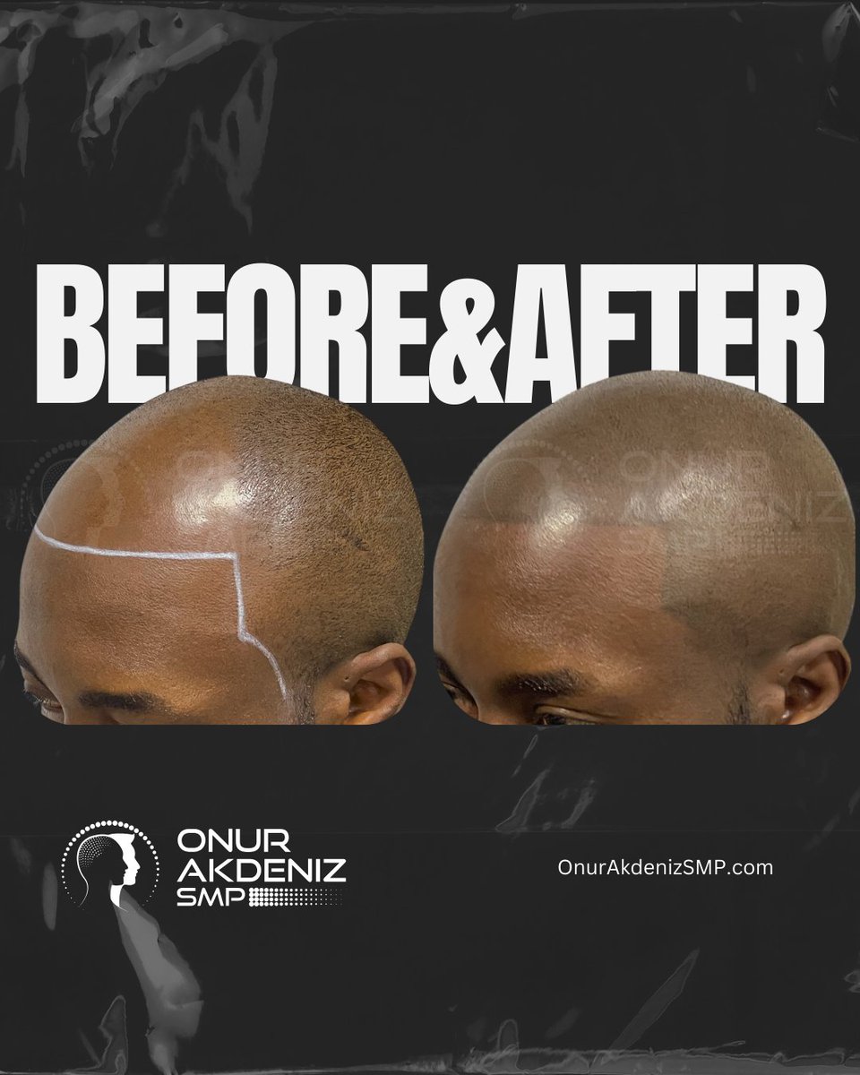 onurakdenizsmp's tweet photo. Check out the before and after of a scalp micropigmentation session in Istanbul, achieving a stunning shaved effect for African American hair. It's all about boosting confidence and embracing a fresh new look! 💪
#ScalpMicropigmentation #Micropigmentation #SMP #MicroPigmentationIstanbul #MicroPigmentationTurkey #OnurAkdeniz