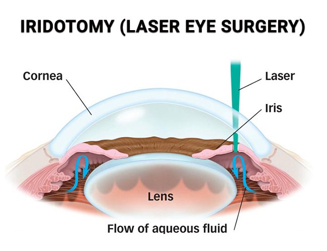 Right eye iridotomy day has arrived - without my right eye landing me in the emergency room, like the left. I am so grateful, and by 14:00 it will all be done.