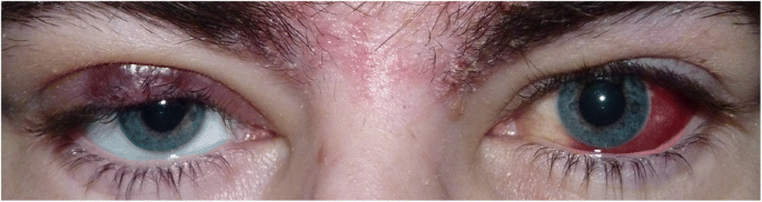 Kaposi’s sarcoma highly vascular, purple-red nodule on the cutaneous aspect of the eyelid/caruncle/conjunctiva. Ophthalmic manifestation in this form may be seen in 25-30% of AIDS cases. #MedTwitter #MedEd #ophthalmology Image from google