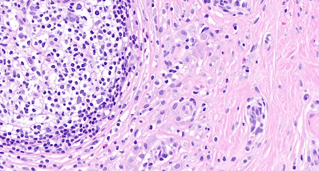 Young child, thigh mass #Dermpath #BSTpath #Pathtwitter