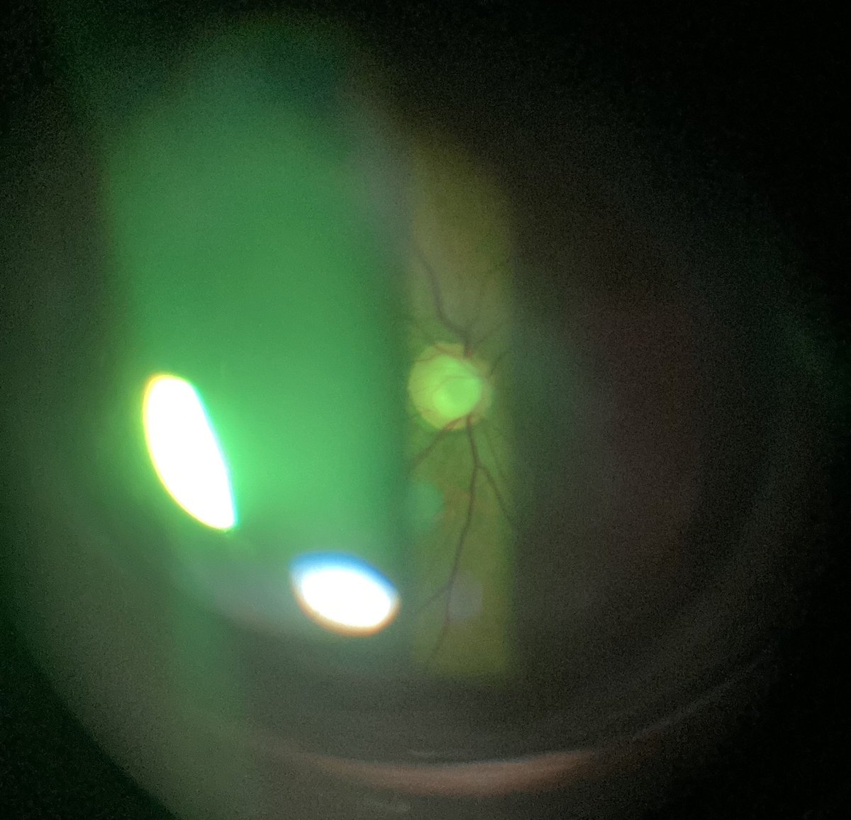 Trying my hand in disc photography. #MedEd #MedTwitter #Ophthalmology #glaucoma