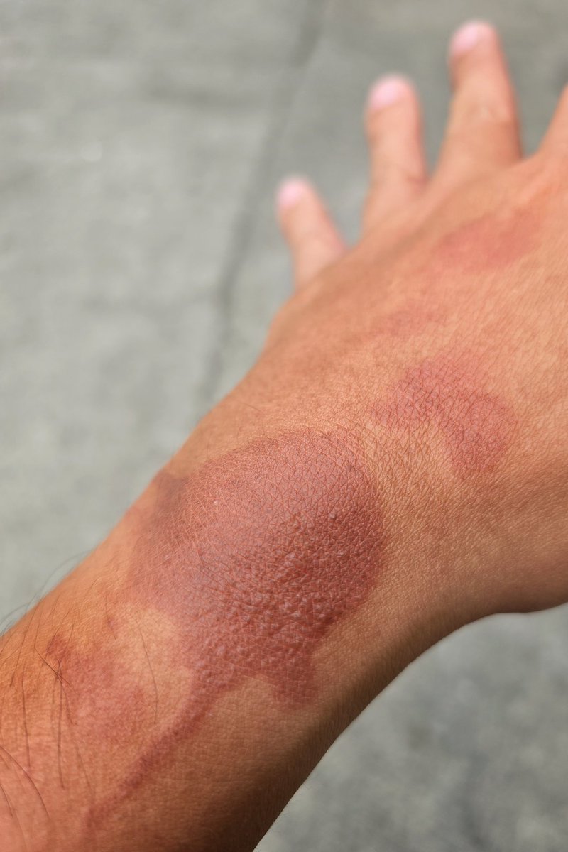 fluidtype's tweet image. Sonofabitch! I managed to achieve peak clumsiness. Burned myself while cooking, on top of my already sunburned skin.  I'm used to it, but shit, this is painful as hell!

I just wanted to eat crispy pata. That's deep fried pork knuckles.

#scald
#crispypata
#homecooked