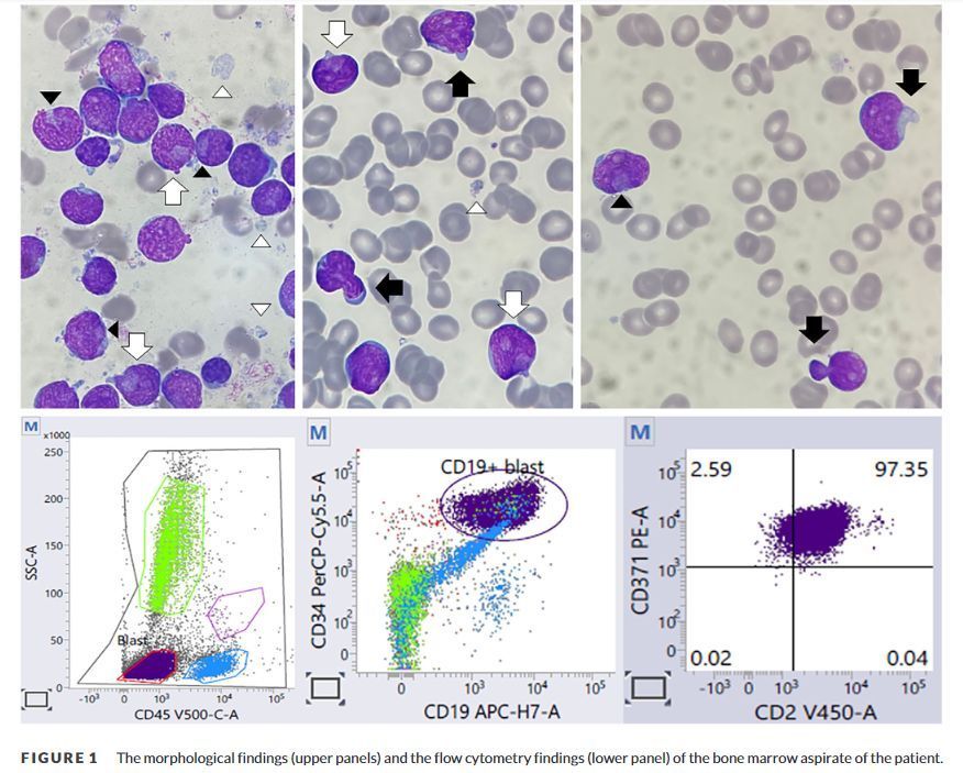 Haematology images: B-lymphoblastic leukemia/lymphoma with DUX4 rearrangement 
buff.ly/44KIy8R