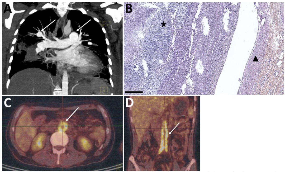 🆕 Scedosporium and Lomentospora 🍄 are frequently (~25%) associated with vascular involvment (aortitis/peripheral arteritis).
⬇️ Imaging pattern and histologic characteristics of patients w/ vascular disease just out in @EIDjournal 

wwwnc.cdc.gov/eid/article/30…