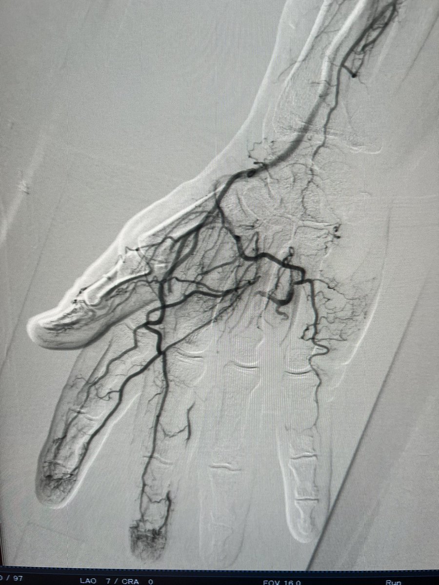 Hypothenar hammer syndrome. Unfortunate case delayed diagnosis (DVT ruled out, symptoms chocked to local trauma), presented later with digital ischemia. Any options for this patient? @t_intheleadcoat @VascularForum @SIRspecialists @drochohan #orthotwitter #medtwitter #vascular