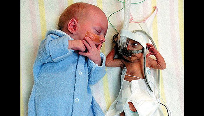 Parents Reject Abortion of One Twin, Save Both Babies buff.ly/2S8dNUL