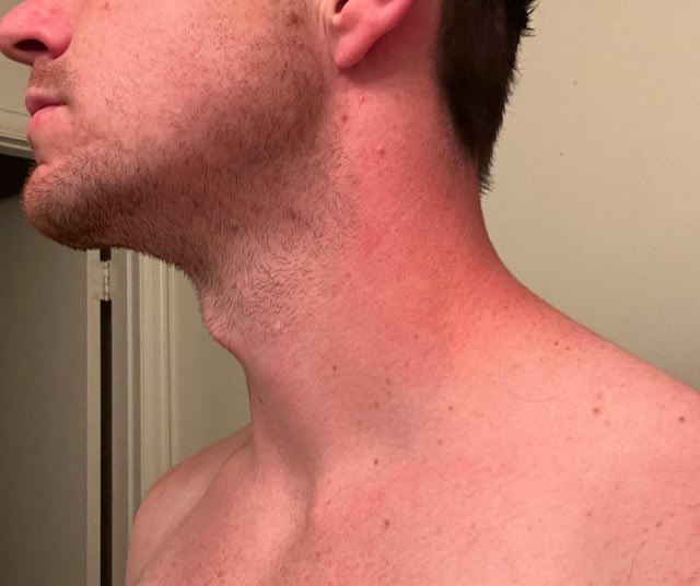 markeatsmeat's tweet photo. Carnivore diet healed his acne
“Name an acne cream or supplement, and l've taken it. I got prescribed Accutane but never took it because of the horror stories I came across.
After reading these stories, | embarked on a journey of trying to heal my gut/skin the 'natural way. This eventually led me down the path of veganism for 8 months. The picture collage you see is my skin at its worst and when I was a full-blown vegan. The more plant matter late, the more acne I got. I lost 15lbs of muscle, anxiety was through the roof, and I was super depressed.
OCD got really bad, and at its peak, I was showering 2-3 times a day, using copious amounts of toxic cleansers and creams, using a new towel every time I showered, and changing my pillowcase every single night (crazy, | know).
I found carnivore a little over 2 years ago, and it was the answer to all of my problems. I noticed improvement within days of cutting out all plant matter. Skin and gut inflammation dropped almost instantly. It took a solid year for my skin to become completely clear. I still get the occasional pimple, but am happy to say my chronic cystic acne journey is now over, and the carnivore 100% healed it, zero question. My weight is back up, not where it used to be (because I was shoving +500g of carbs down my throat a day), but I like where l'm at. Mental health is better than ever as well.”
https://t.co/uQXYpgEEJ7
