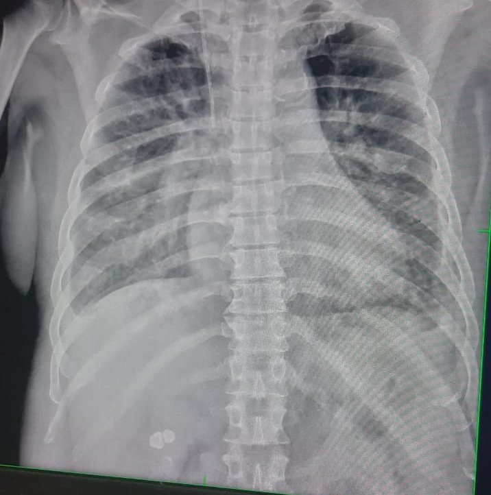 65 Y old male K/C/O CKD , presented with a sudden onset of breathlessness, O/E- BP - 220/120 mmHg What is the diagnosis? What is the treatment?? #MedTwitter #Medx