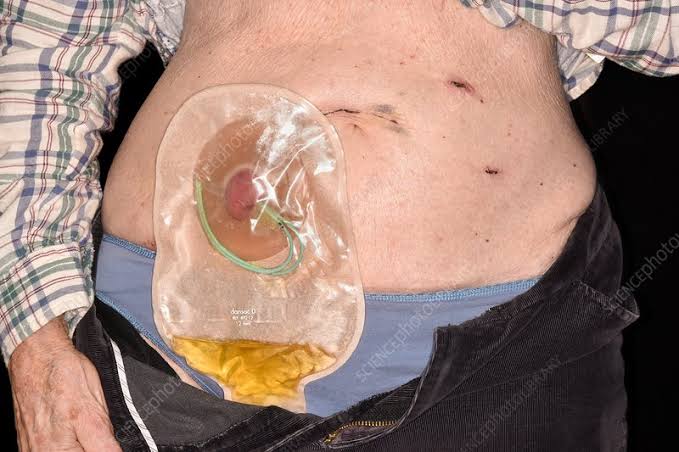 Bismillaah
Thread lanjutan Kanker Kandung Kemih

Kenapa di thread yang pertama sy menekankan bahaya merokok yang berhubungan dengan kejadian kanker kandung kemih, karena berkaitan dengan penanganan kanker tersebut.
Bilamana kanker masih stadium awal, maka dilakukan operasi dengan