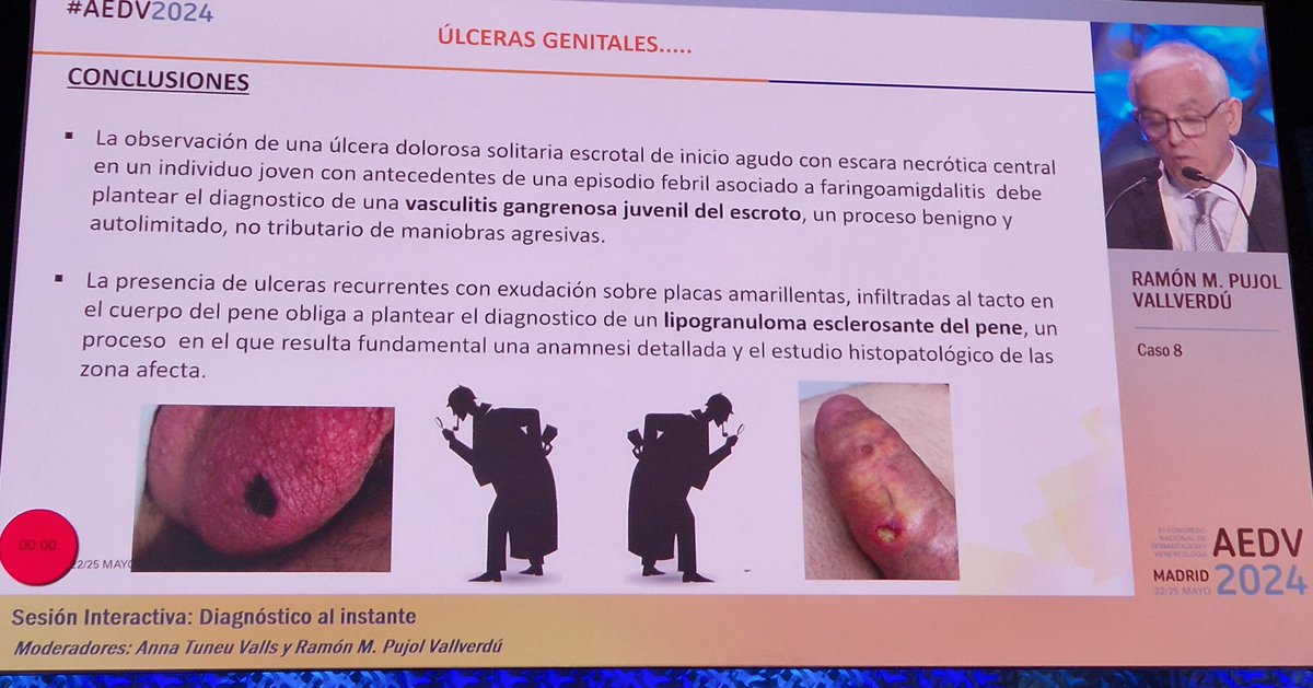 No todas las úlceras genitales son enfermedades venéreas
@drRamonPujol nos presenta una vasculitis gangrenosa juvenil del escroto y un lipogranuloma esclerosante del pene por infiltraciones de 'pomada de Kanamicina'. 
#AEDV2024
#Dermatología
#ITS #enfermedadesvenereas