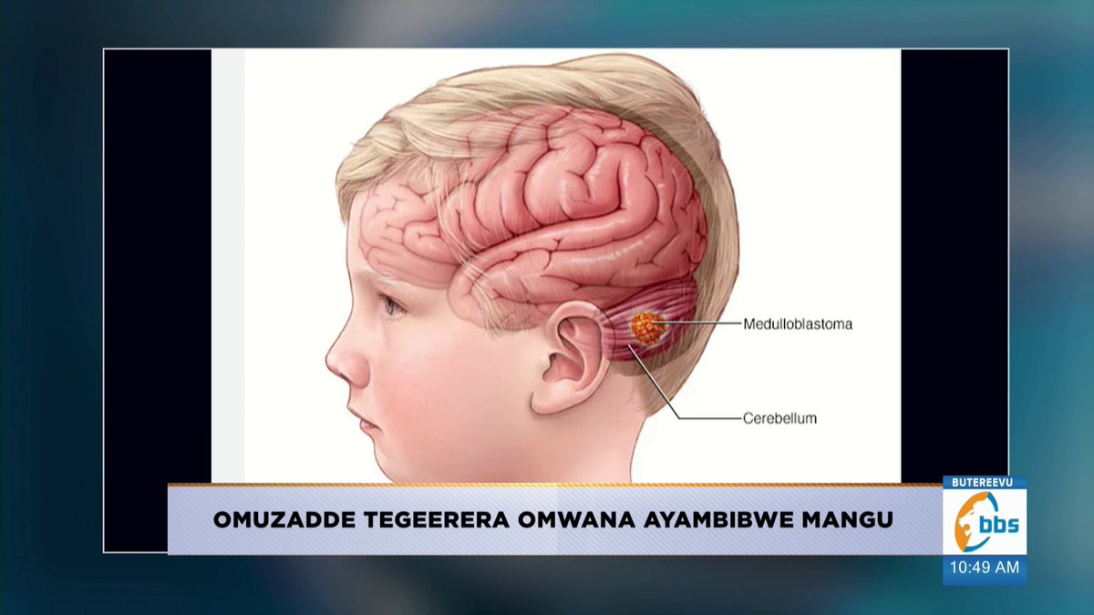 Obubonero kw’olabira omuntu omulwadde wa Kkookolo w’obwongo bwawukana okusinziira ku myaka gy’omuntu ng’omwana atanatandika kwogera akaaba kaaba buli kaseera, azimba omutwe, okuddirira mu bintu omwana byabadde akola okugeza nga omwana abadde ayavula okudda emabega. Ate mu baana