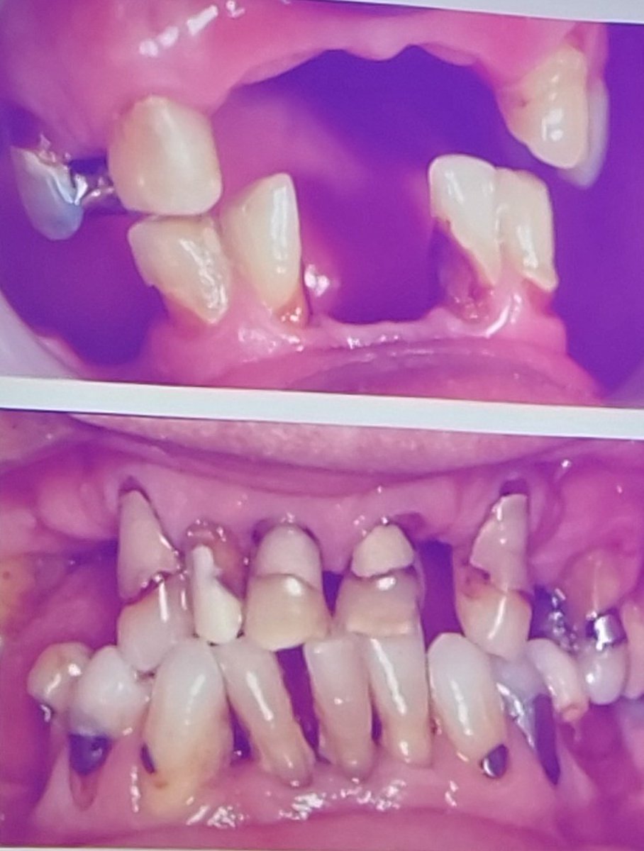 80% of medications have xerostomia (dry mouth) as a side effect. This causes dental decay, mouth discomfort, and makes wearing dentures uncomfortable. Once root caries set in, it is very difficult to manage #BGSconf