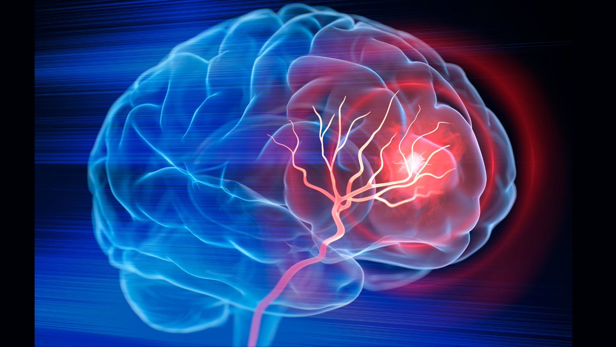 New rapid blood test can accurately detect stroke in 6 hours, save lives @IntEngineering #HealthTech #Healthcare #AI #IoT #5G @ipfconline1 @mvollmer1 interestingengineering.com/health/blood-t…