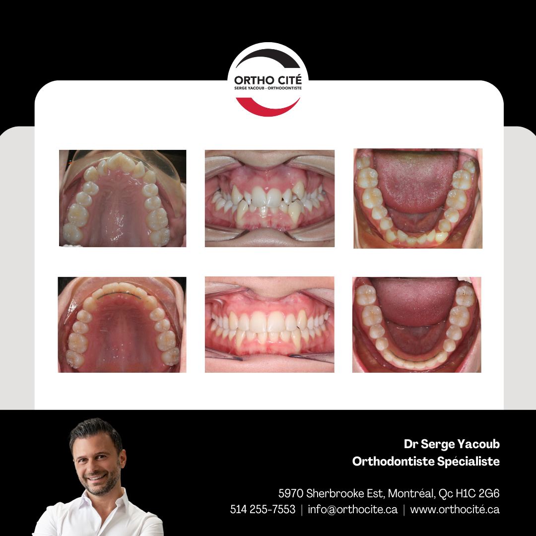 #findetraitement
Constriction du maxillaire supérieur traité par expansion palatine & alignement dentaire.
.
#endoftreatment
Constriction of the upper jaw treated by palatal expansion & dental alignment.
.
#orthocité #drsergeyacoub #orthodontiste #montréal #smiledesign #orhtomtl