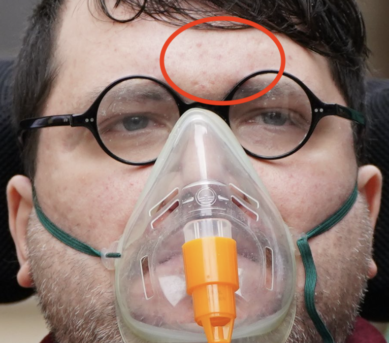 2AMAnnie's tweet photo. As if f'prints aren't enough, anyone still being convinced by this psychopath needs to take a dekko at his noggin - scarring is there as both #NicholasRossi and Arthur "Round Table'" Knight. Should have used cosmetic filler/gone to #Specsavers #ImposterBackFromTheDead @Channel4 https://t.co/Shcg1SSS6r