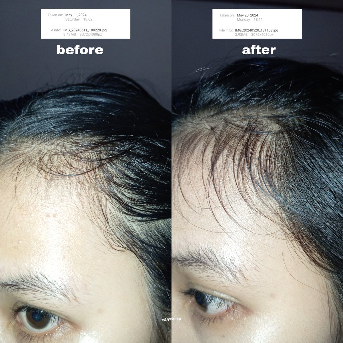 glycolica's tweet photo. seneng deh nemu hair serum yang work buat bantu numbuhin baby hair ku jadi lebat gini... 😭

sangat membantu buat yang rambutnya sering rontok kaya aku 👍 https://t.co/JjYOAEiRhj