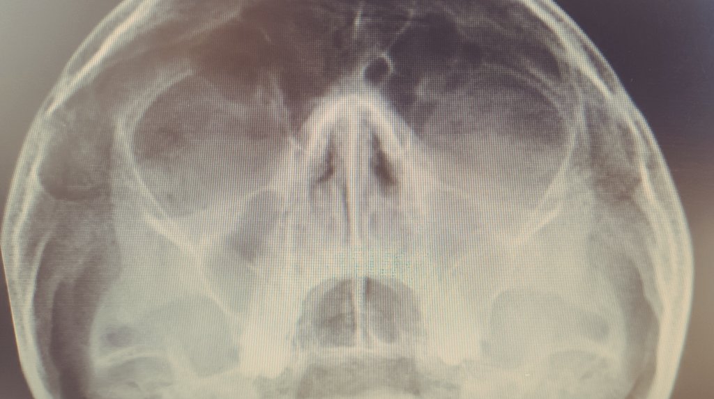 2 ciclos de amoxicilina porque no se 'curaba la sinusitis '. Por favor, dejen de medicar radiografías.