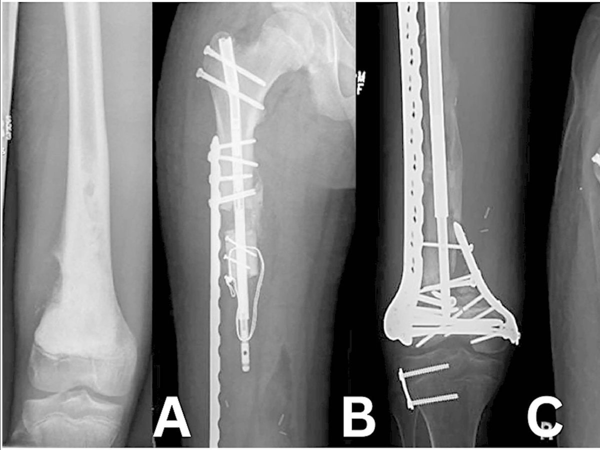 Distraction Osteogenesis Reconstruction Following Resection of Bone Sarcomas
#oncology

bit.ly/4bENfTM