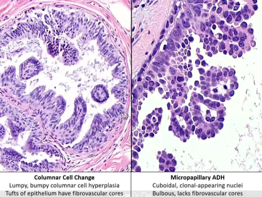 #Breastpath  
🧵Challenging differential diagnosis 
Columnar cell changes and micropapillary ADH
Dr Sciallis Cleveland Clinic MPS #EverydayBreast #pathtwitter #PathX #pathology #PathResident #NIPPathX