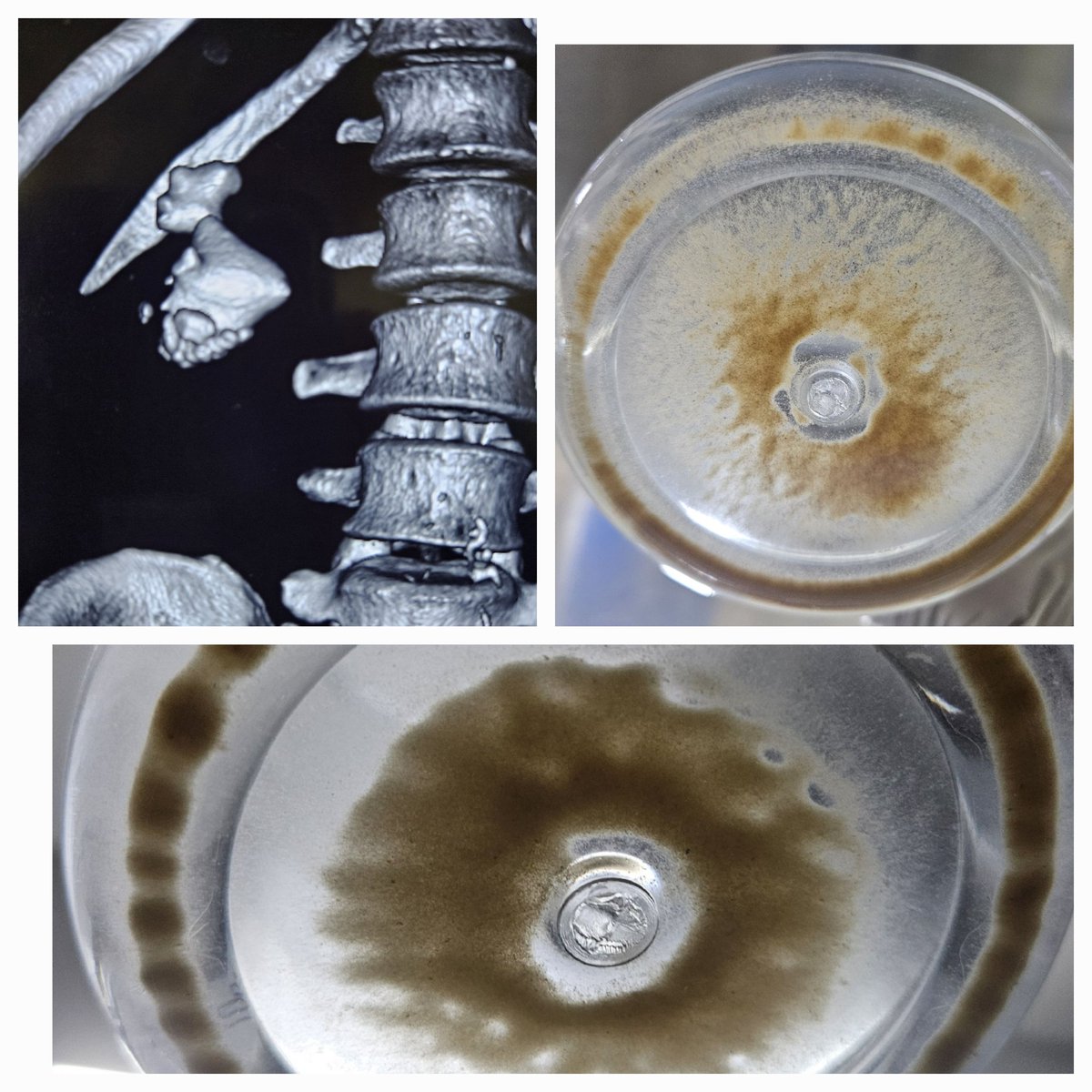 RIRS : DISS : safest RIRS ( new generation RIRS : sheathless/ wireless/ FLUOROLESS): 85th STAGHORN : 2.6x3.9x6.1 CM calculus Endoluminal endourology:a reality in future: @OTRAXER @DocGauhar #UroSoMe @mohamed92902484 @rocamed @Dmitry_Enikeev @CanesDavid @DrVCMohan @CAU_URO