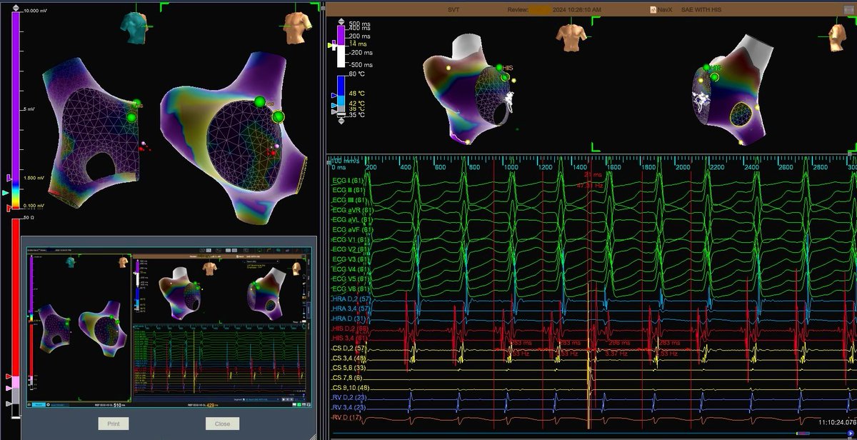 Creative simple maneuver for use in differential diagnosis of AT versus AVNRT. SAE (Single Atrial Extrastimulation) a look at simultaneous resetting. sciencedirect.com/science/articl… #PMA #SVT @JeffHsingMD @AbbottCardio