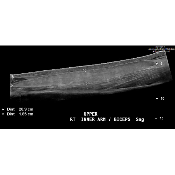 A 25-year-old woman presents with arm swelling and pain 3 days after a long workout at the gym. #ACRCaseinPoint bit.ly/4bukf19
