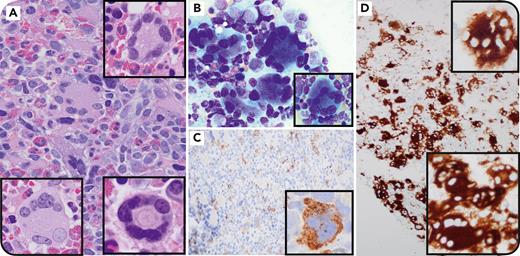 “Ring-form” megakaryocytic dysplasia in STAG2-mutated myelodysplastic neoplasm ow.ly/qlyl50RTHMc #bloodwork #hematopoiesisandstemcells #myeloidneoplasia