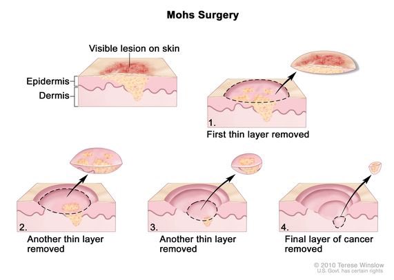 Treatment of skin cancer. These include surgery (usually under a local anaesthetic), ointments, radiotherapy, cryotherapy, curettage (scraping), or cautery (burning) and intralesional chemotherapy. Always consult a medical professional for the best option. #SkinCancerAwareness