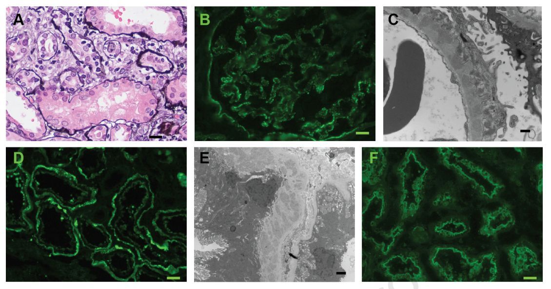 Anti-Brush Border Antibody Disease: A Case Series Authors report 9 patients presenting with acute kidney injury, highlighting the poor prognosis of ABBA disease & potential benefit with anti B cell therapy or treatment of the underlying malignancy. buff.ly/3QS2jp9