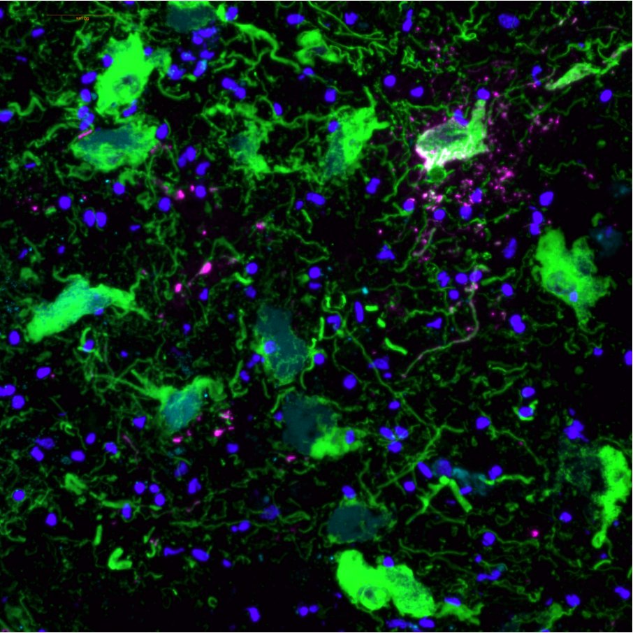 Keri Martinowich (@martinowk) on Twitter photo Tyrosine hydroxylase and Tau in the human locus coeuruleus. Image credit to LC enthusiast research assistant (and soon to be <a href="/HopkinsNeuro/">Hopkins Neuroscience</a> grad student!!!) <a href="/HeenaDivecha/">Heena Divecha</a> 🔵🔬🧠😍
#FluorescenceFriday Tyrosine hydroxylase and Tau in the human locus coeuruleus. Image credit to LC enthusiast research assistant (and soon to be <a href="/HopkinsNeuro/">Hopkins Neuroscience</a> grad student!!!) <a href="/HeenaDivecha/">Heena Divecha</a> 🔵🔬🧠😍
#FluorescenceFriday
