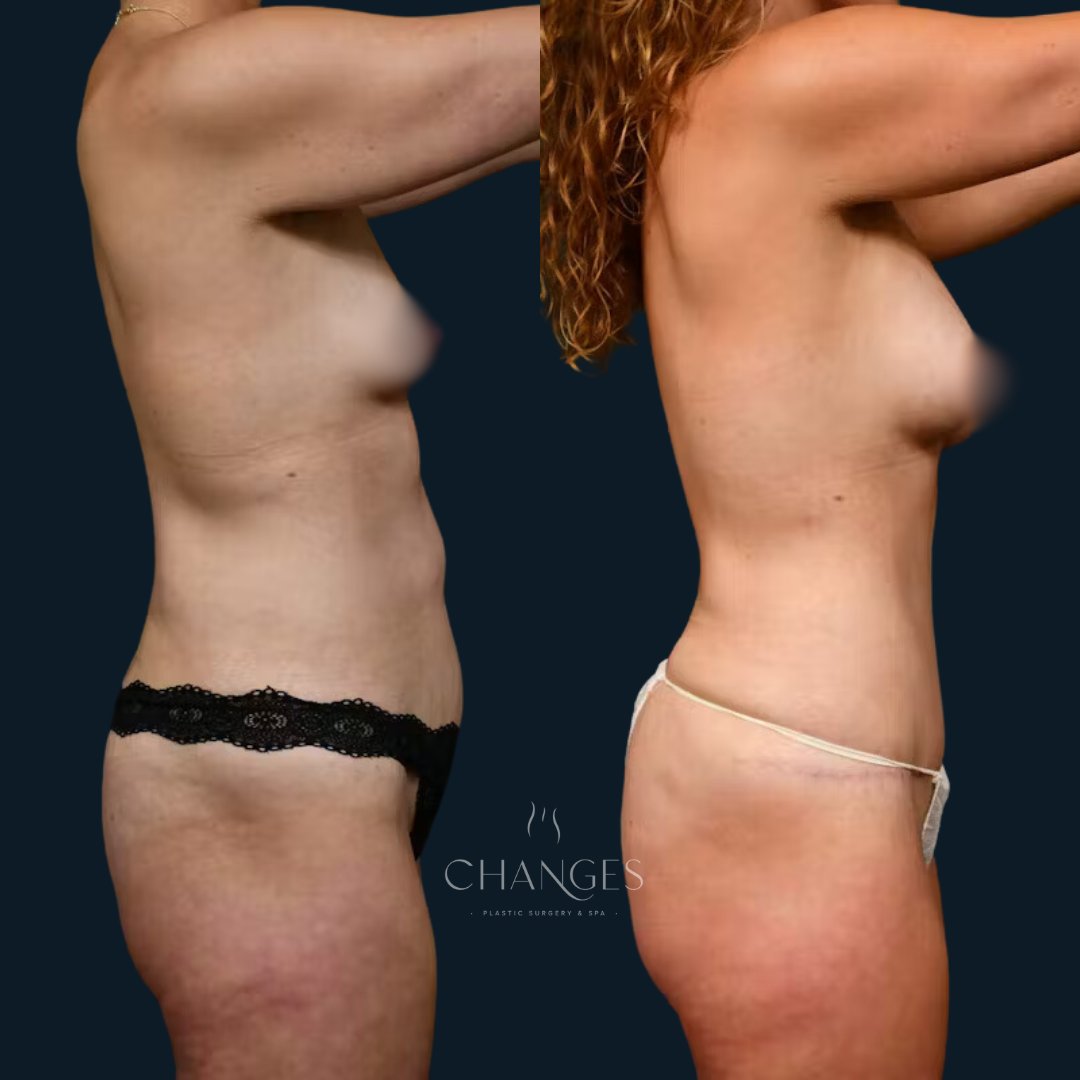 ChangesPlastic's tweet photo. Ready to take back your body? 💭 Abdominoplasty, Liposuction, and the perfect enhancement with Fat Grafting created these stunning results. 💖 
⁠
SWIPE → to see these results from different angles! Also, book a consultation at the link below.

https://t.co/nFZ2wel59m https://t.co/YUcG8hS8Fc