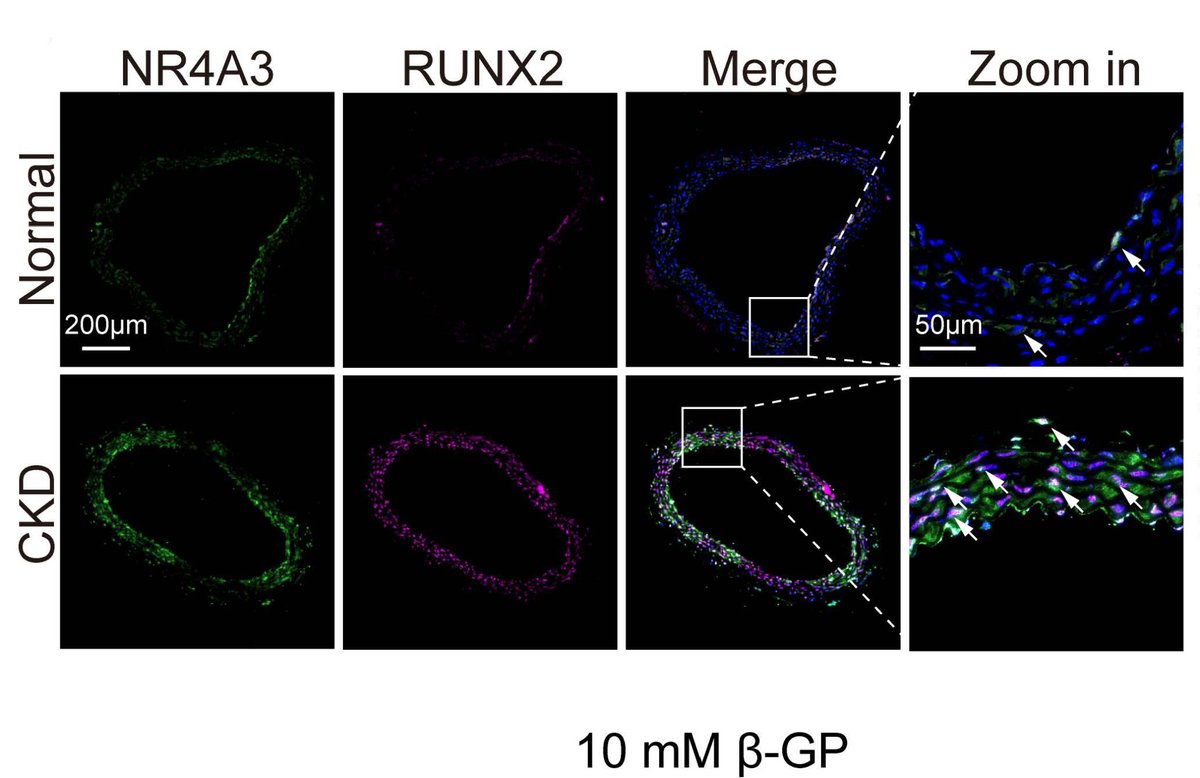 Ma & colleagues found that lactate accumulation mediated by #NR4A3 promotes the progression of medial #arterial #calcification through histone #lactylation. Learn more about how to limit #vascular calcification at ahajrnls.org/4bvT1az