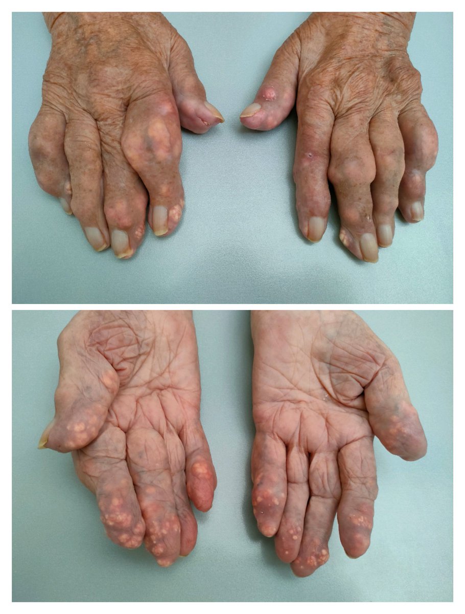 &gt;20 anys d'evolució, sempre li han dit "que tiene una artrosis muy mala", mai ha sentit a parlar de l'àcid úric o de la gota. Amb prou feines pot agafar la forquilla per menjar. Cal major visualització i coneixement d'aquesta malaltia en tots els àmbits!