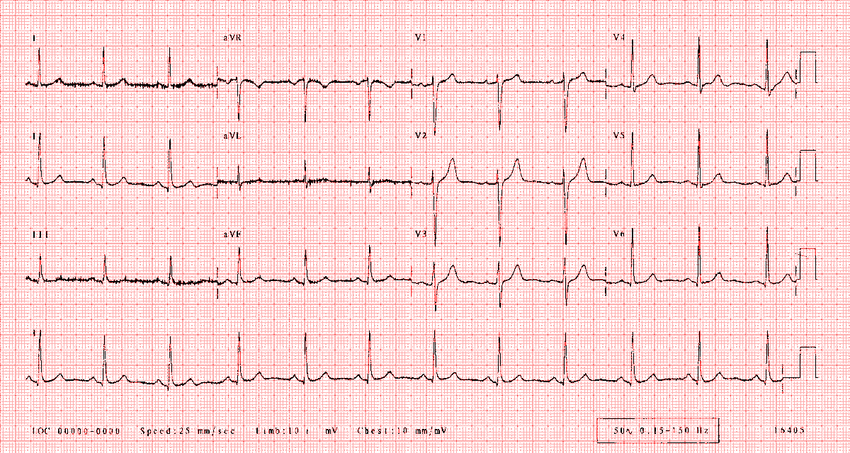 drkamikhan123's tweet photo. Must-Know ECGs for USMLE: A Comprehensive Thread 🧵
===≈=====
1/ Normal Sinus Rhythm

Regular rhythm, 60-100 bpm.
P waves before each QRS, consistent P-R interval (0.12-0.20 s). https://t.co/Lsj9WOk4DI