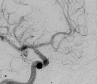 PenNeuro's tweet photo. US HCPs: Bilobed, ACOM aneurysm managed with #BMX96 and 3 #PC400 .020โ coils for 50% packing density. See below for the 6-month follow-up. Courtesy of Dr. Huseyin Tore in La Crosse, WI! #followupfriday
For risk info: https://t.co/hzWEQEQmfZ. Clinical results may vary. https://t.co/tUuDaY12TC