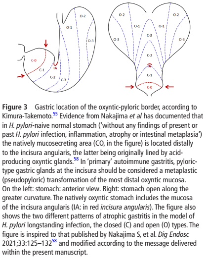 IBDGastroDocSg's tweet photo. Kimura-Takemoto classification
- classifies atrophic gastritis by locating the atrophic border in the stomach
- closed: border remains on the lesser curve
- open: border extends into anterior and posterior walls of the stomach

#GITwitter https://t.co/F2BnnRYTq8