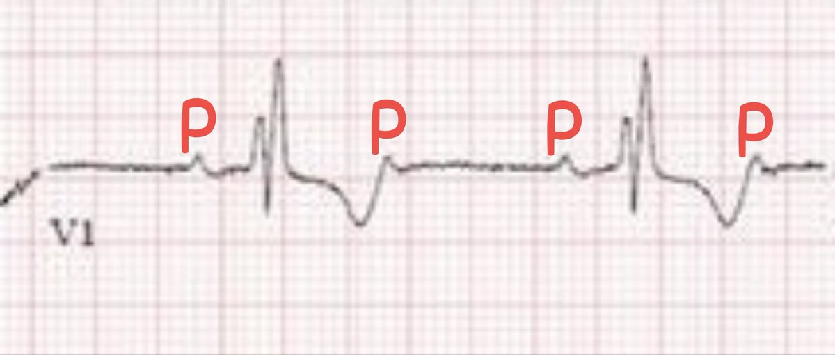 @heartsECGcourse ①Sinus Tachycardia with '2:1 AV block'+'CRBBB'+'LAFB'
➡This patient has a high risk of developing to 'Complete Heart Block'🧐🧐🧐

②S Ⅲ+Max R(any lead)＞3.0mV
➥s/o Left Ventricular Hypertrophy(LVH)